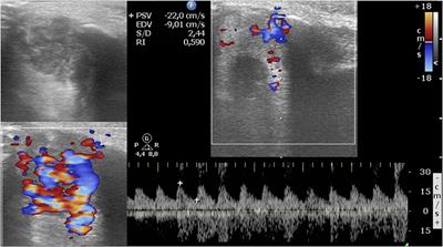 Color Doppler Evaluation of Arterial Resistive Index in Infantile Hemangioma: A Useful Parameter to Monitor the Response to Oral Propranolol?